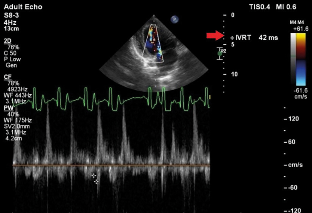 Imagem ecocardiográfica de um cão evidenciando redução do tempo de relaxamento isovolumétrico (seta vermelha). Créditos: Laciv HV-UFPR 